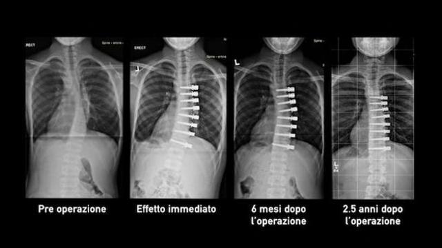 curacontroscoliosi calatafimed