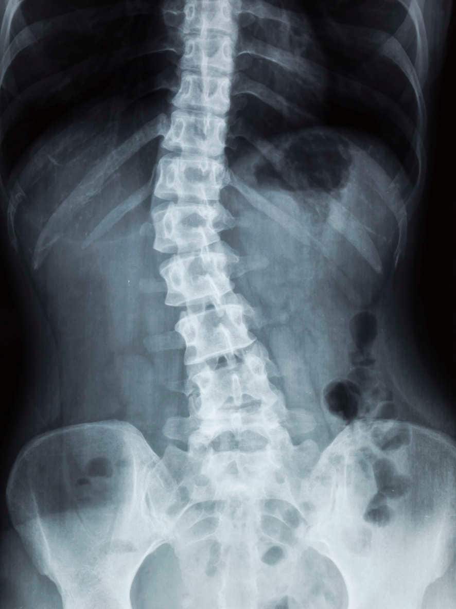 scoliosi rx calatafimed
