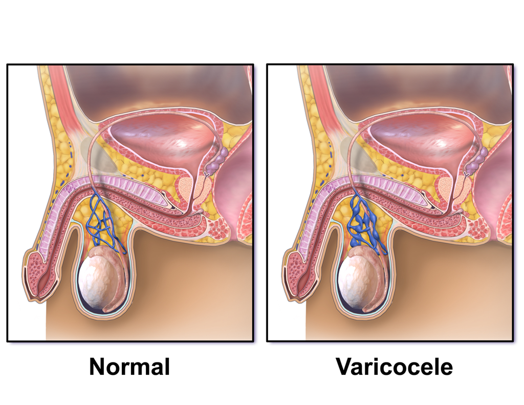 Varicocele calatafimimed