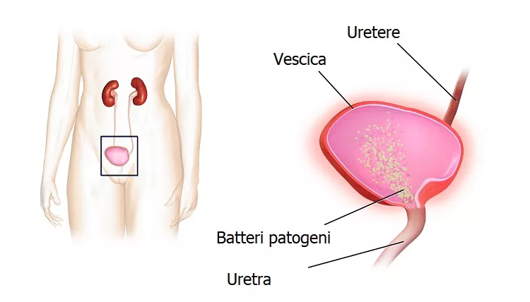 cistite calatafimed