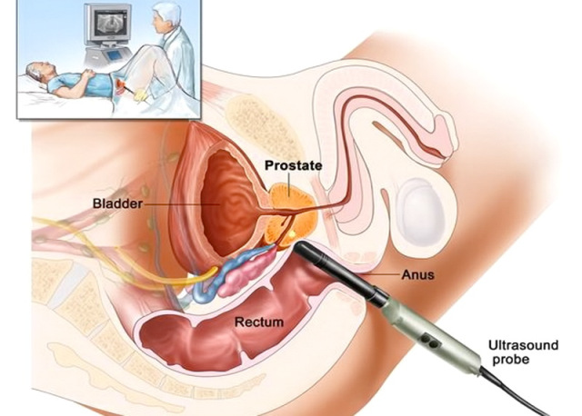 ecografia prostat. transrettale calatafimimed